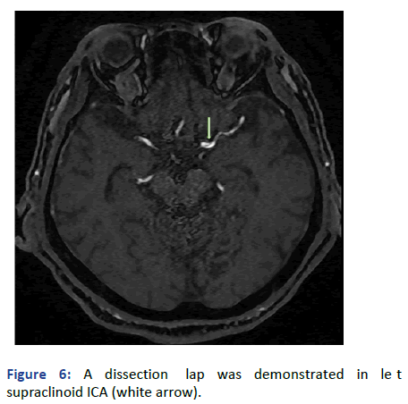 Imaging-Radiology-supraclinoid