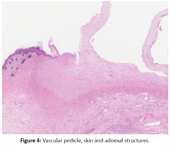 gynecology-obstetrics-case-report-adnexal