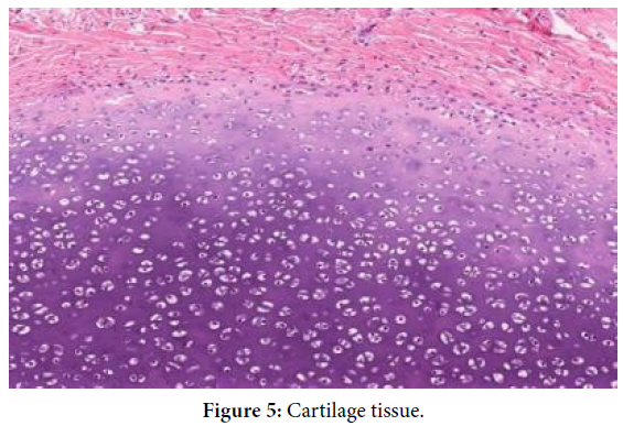 gynecology-obstetrics-case-report-cartilage-tissue