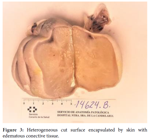 gynecology-obstetrics-case-report-edematous