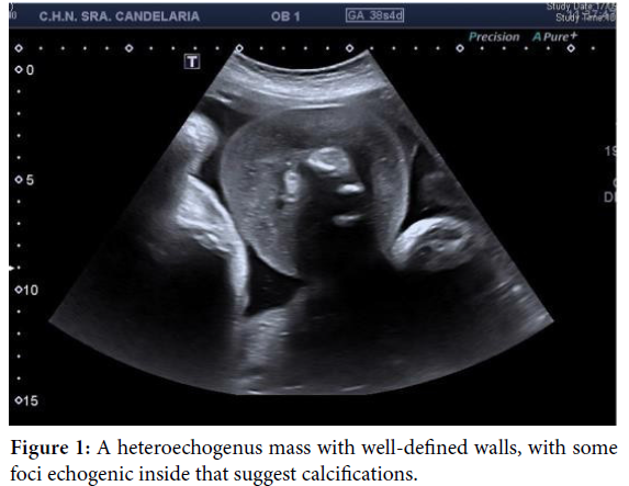 gynecology-obstetrics-case-report-heteroechogenus