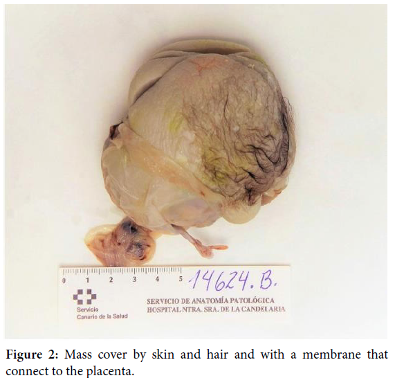 gynecology-obstetrics-case-report-membrane