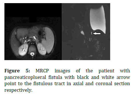 ipp-MRCP