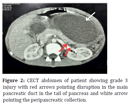 ipp-abdomen