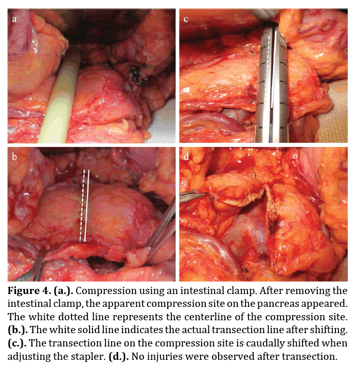 Pancreas-compression-intestinal-clamp