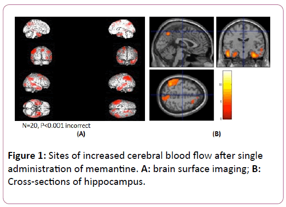 british-journal-increased-cerebral-blood