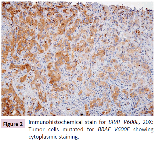 clinical-epigenetics-Immunohistochemical-stain-BRAF