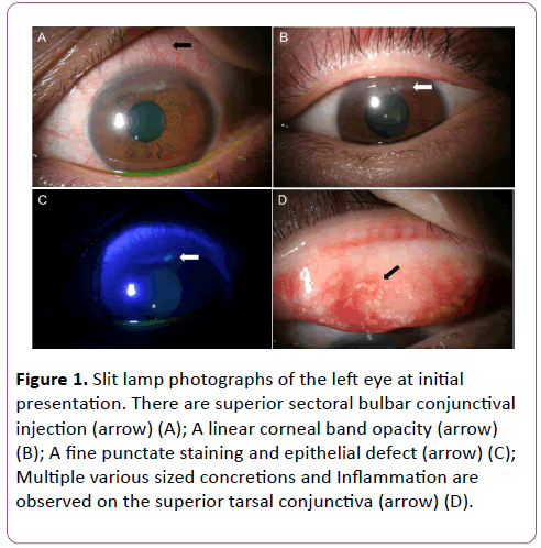 conjunctival injection