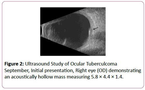 eye-cataract-surgery-Ultrasound-Study