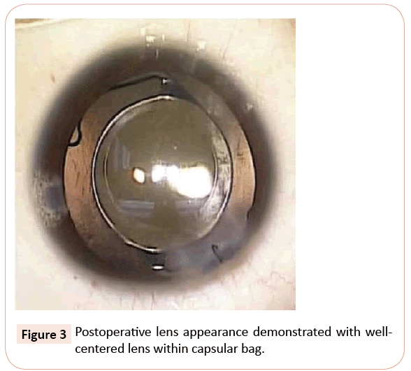 eye-cataract-surgery-capsular-bag