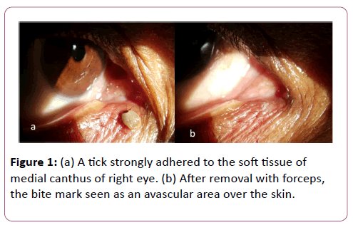 eye-cataract-surgery-medial-canthus