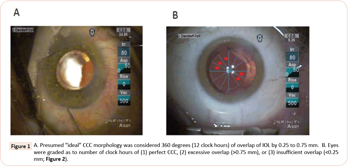 eye-cataract-surgery-number-clock