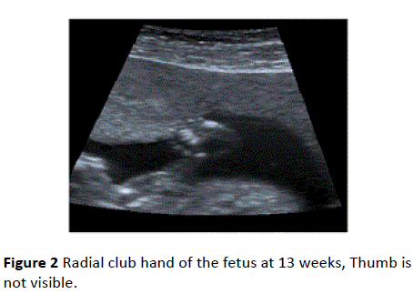 gynecology-obstetrics-Radial-club-hand