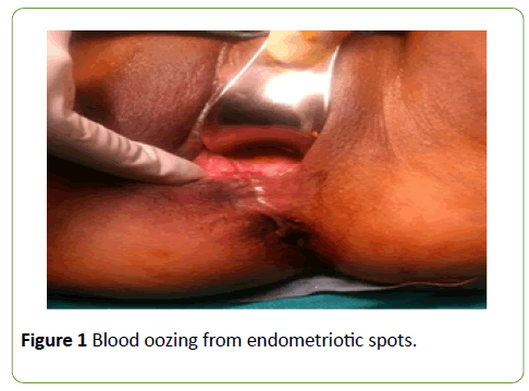 gynecology-obstetrics-blood-oozing