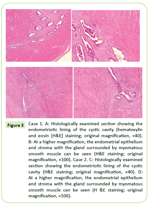 gynecology-obstetrics-endometriotic-lining