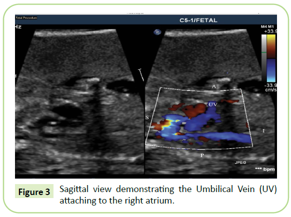 Umbilical Vein Connection to Right Atrium with Absent Ductus Venosus: A ...