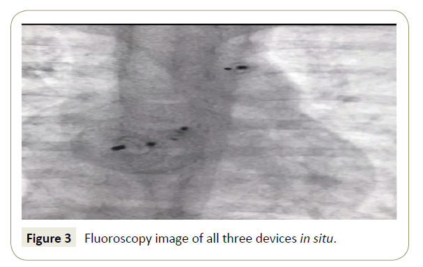 interventional-cardiology-Fluoroscopy-image