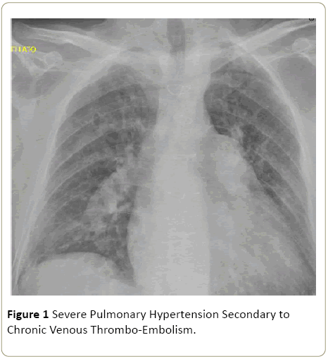 interventional-cardiology-Pulmonary-Hypertension