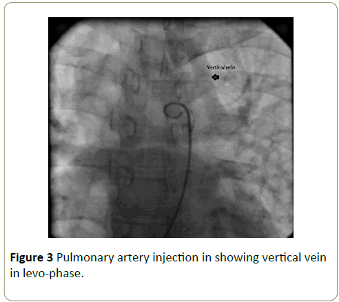 interventional-cardiology-Pulmonary-artery