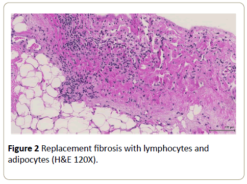 interventional-cardiology-Replacement-fibrosis-lymphocytes