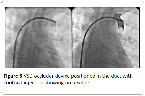 interventional-cardiology-occluder-device