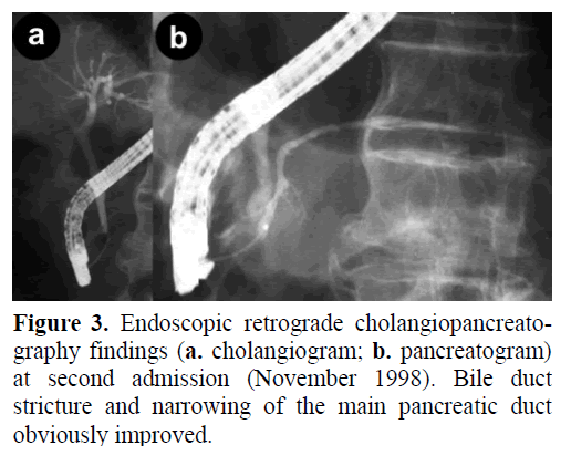 pancreas-Endoscopic-cholangiopancreatography