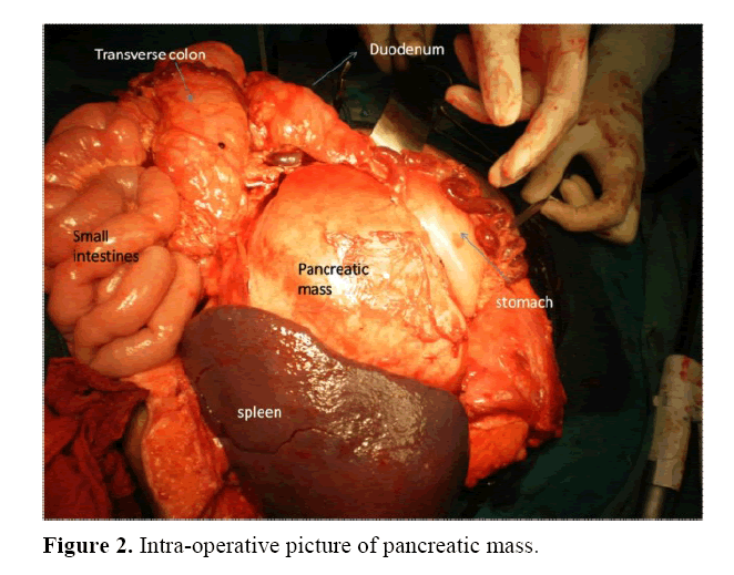 pancreas-Intra-operative-picture