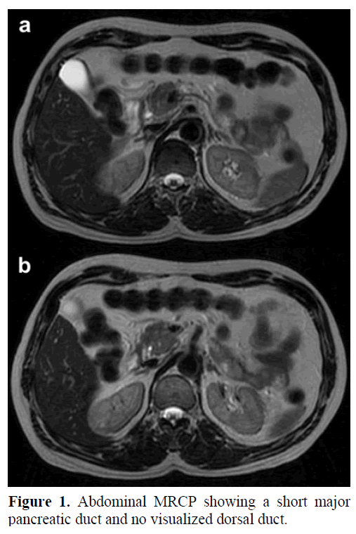 pancreas-abdominal-mrcp-short-major