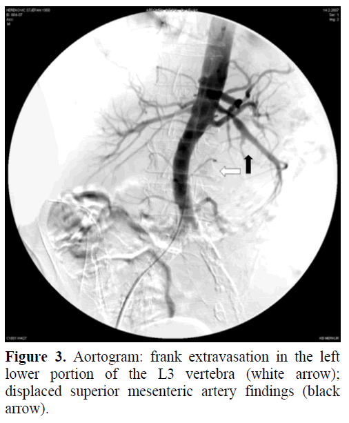 pancreas-aortogram-frank-extravasation
