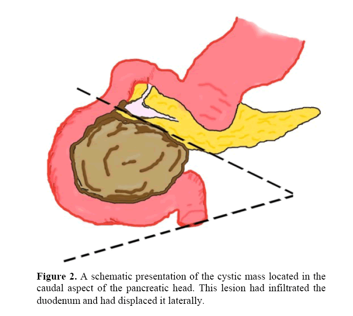 pancreas-aspect-pancreatic-head