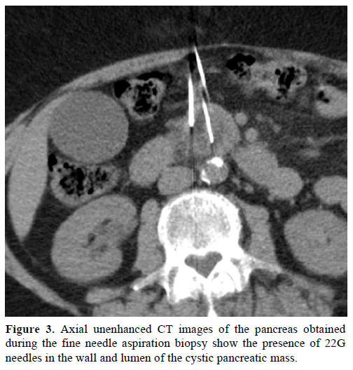 pancreas-axial-unenhanced-ct-images