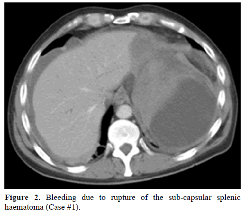 pancreas-bleeding-rupture-sub-capsular