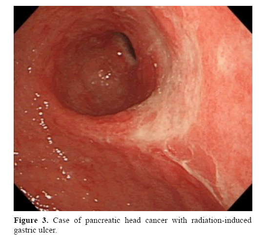 pancreas-cancer-radiation-induced