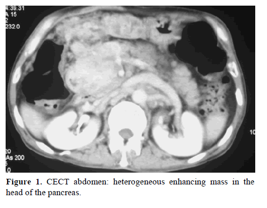 pancreas-cect-abdomen-heterogeneous
