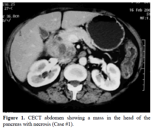 pancreas-cect-abdomen-mass-pancreas