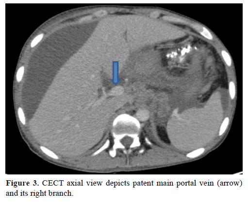 pancreas-cect-axial-main-portal-vein
