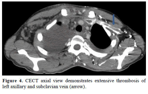 pancreas-cect-axial-subclavian-vein