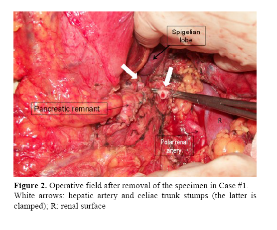 pancreas-celiac-trunk-stumps