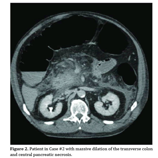 pancreas-central-pancreatic-necrosis