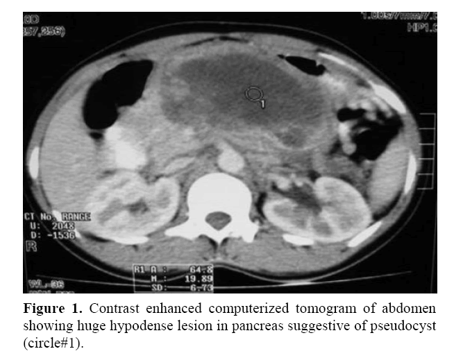 pancreas-circulating-tumor-cells