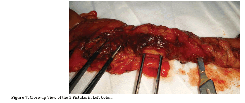 pancreas-colon