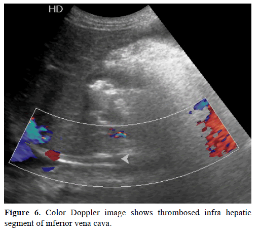pancreas-color-doppler-thrombosed-infra