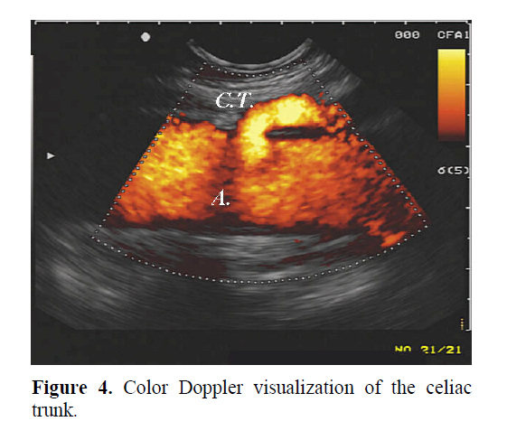 pancreas-color-doppler-visualization