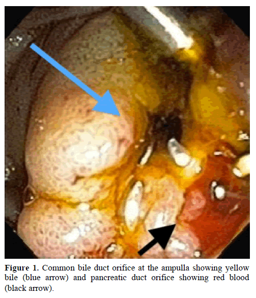 pancreas-common-bile-duct-orifice