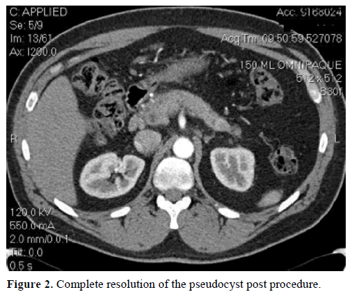 pancreas-complete-resolution