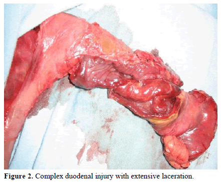 pancreas-complex-duodenal-injury