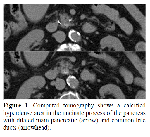 pancreas-computed-tomography-hyperdense