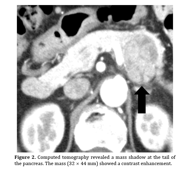 pancreas-computed-tomography-revealed