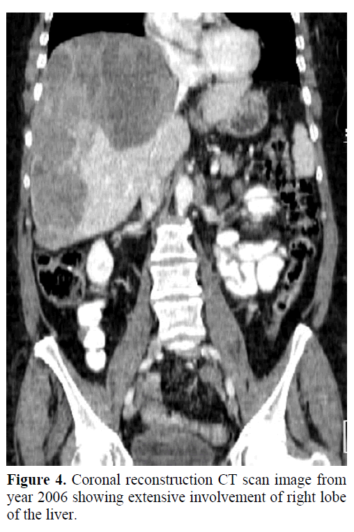 pancreas-coronal-reconstruction-ct-scan