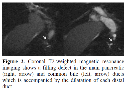 pancreas-coronal-t2-weighted-magnetic